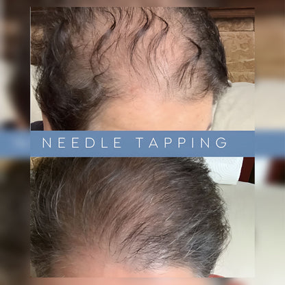 PlumStar Dermal Hammer Set