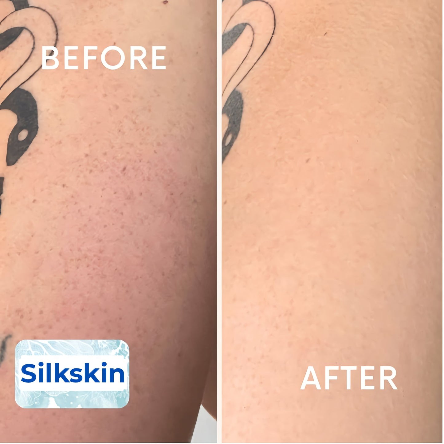 SilkSkin™